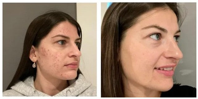 Kojic Acid Turmeric Cleansing Pads Beauty Hot-sale