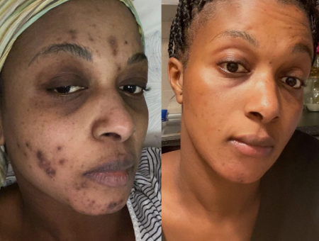 Pads Nettoyants Éclat BoProSan™ au Curcuma & Acide Kojique – Nettoyer, Exfolier, Unifier